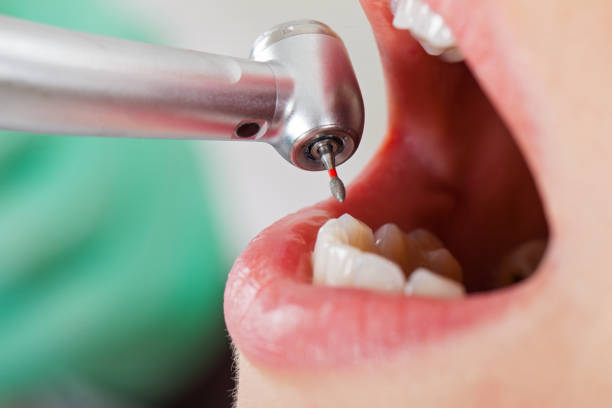 Best Dentist for Tooth Abscess  in Crownsville, MD